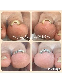 福屋/巻き爪ケアもお任せ♪