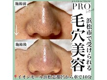 セミル(SEMIRU)/毛穴改善コース