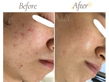 ミラリー(MIRALY)/頬慢性ニキビケア 8ヶ月(20代)