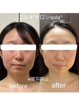 ソラ(sola*)/フェイスラインスッキリ