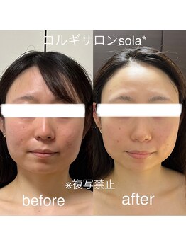 ソラ(sola*)/フェイスラインスッキリ
