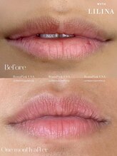 ウィズリリナ 新横浜(with Lilina.)/ローマピンク　術後1ヶ月