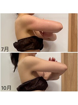 プララン(Plaran)/挙式に向けて上半身痩せ★