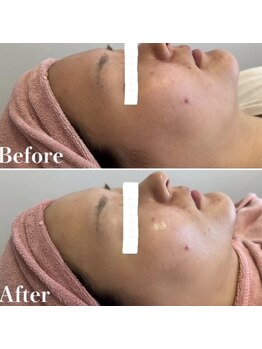 アミティエ 恵比寿駅前店(Amitie)/毛穴洗浄×顔脱毛×美容液導入