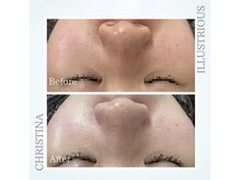 シャルムパリス(charme paris)/毛穴の汚れ◎１回の施術変化