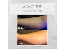 シェア(SHARE)の雰囲気（2週間に1度のスピード脱毛が大人気！お肌を整える効果あり！）