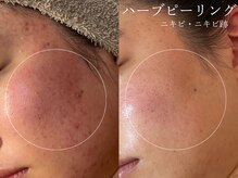 クレスト(CLEST.)/ハーブピーリング