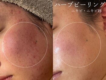 クレスト(CLEST.)/ハーブピーリング