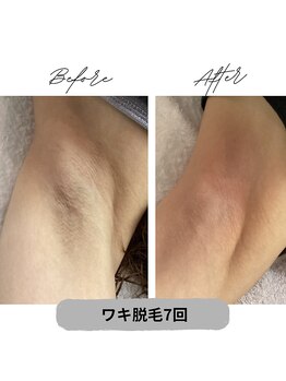 プレジール 大野城店(plaisir)/ワキ脱毛