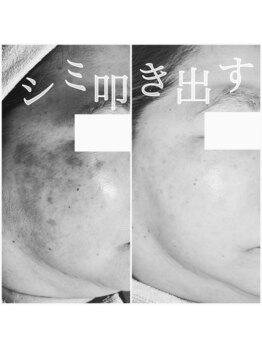 ルボン 宮崎店(RUBON)/塗るシミケアの効果