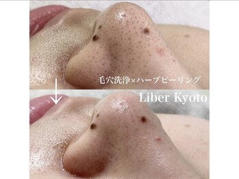 エステティック リベル キョウト 京都駅前店(Esthetic Liber Kyoto)/毛穴洗浄×ハーブピーリング