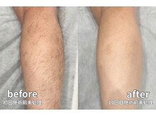 痛みや熱さが少ないのに、しっかり実感できる脱毛