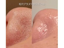 サロン ソワイユ(salon soyeux)の雰囲気（小鼻の毛穴の黒ずみや開き・たるみのお悩みもスッキリ♪北野田）