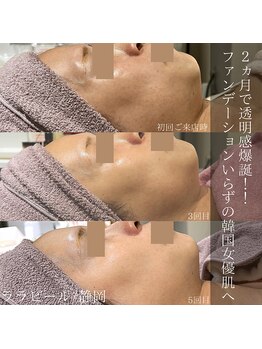 アウラプラス(Aura+)/くすみ症例/