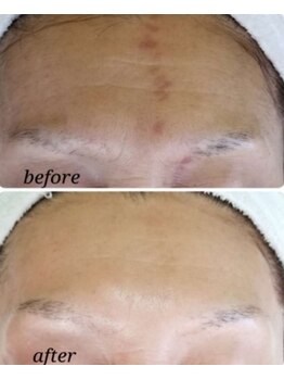 ファルファラ(farfara)/天然ハーブピーリング