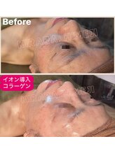 キララ 美容矯正/70代のお客様。