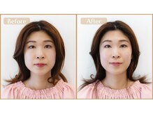 グラン治療院 東京/美容鍼　ビフォーアフター