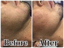 ルリアン(LeLien)/顎なし髭脱毛　施術５回の効果！