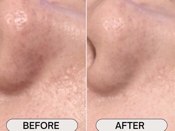 ココリラ(cocorira)の写真/徹底毛穴洗浄で広がった毛穴をケア！ニキビもケア、つるんとした透明感肌へ導く◎