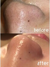Ruche/毛穴洗浄【before after】