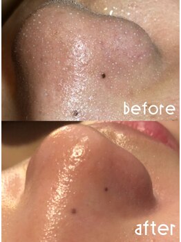 Ruche/毛穴洗浄【before after】