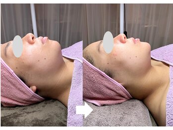 レーヴリゼ(Revelise)/ララピール+ララピールパック