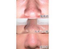 イチキュービー 仙台駅前東口店(19B)/毛穴吸引　Before＆After