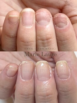 マリーロール 淀屋橋本店(Marie Laure)/自爪育成/深爪矯正/ネイルケア