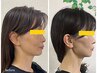 【レモンボトル】脂肪分解で小顔効果!お顔のたるみ改善ケア￥10,000→￥7,700