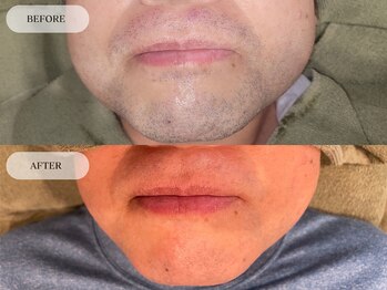 メンズプラス(MEN’S PLUS)/ヒゲ脱毛/ビフォーアフター写真