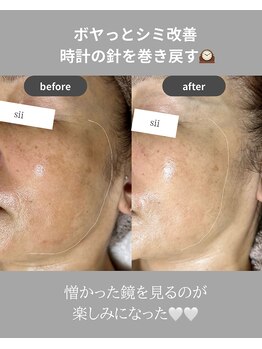 シイ(total skin beaute sii)/50代　肌質改善