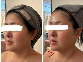 ユフラ(Juhla)/切らない小顔リフト