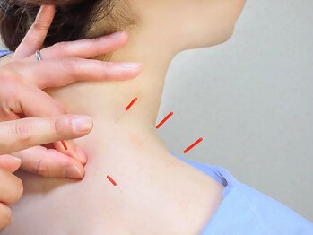 鍼灸整体院ワト 三軒茶屋院(鍼灸整体院WATO)/■首・肩の鍼灸施術例