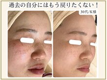 ポモナ 横浜馬車道店(Pomona)/シミ＆細かいシミも施術可能◎