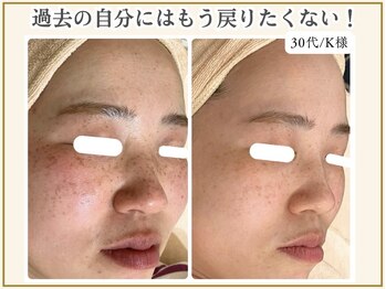 ポモナ 横浜馬車道店(Pomona)/シミ＆細かいシミも施術可能◎