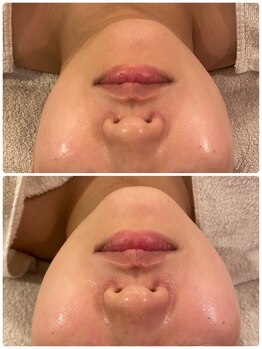 うつくし痩身 美サロン ゼットワン(Z-ONE)/カーボキシーセラピbeforeafter