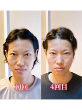 小顔22 ボルティ 赤坂支店(Bolty)/【悩み】40代：角ばった顔の輪郭