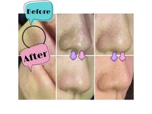 ベルミーランド イオン長浦/夏に向けて皮脂撃退！