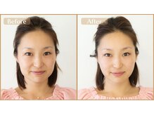 グラン治療院 東京/美容鍼　ビフォーアフター