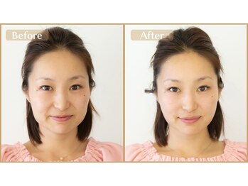 グラン治療院 東京/美容鍼 ビフォーアフター