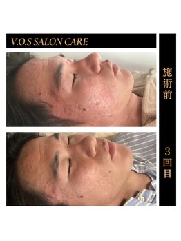 サロン リノア(Salon Linoa)/ 肌質改善！ vosサロンケア黒