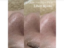 エステティック リベル キョウト 京都駅前店(Esthetic Liber Kyoto)/毛穴洗浄×ハーブピーリング