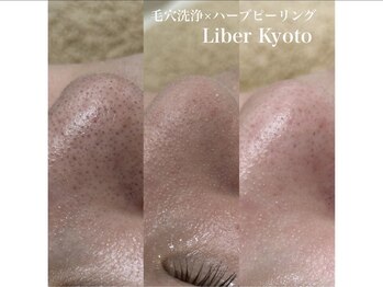 エステティック リベル キョウト 京都駅前店(Esthetic Liber Kyoto)/毛穴洗浄×ハーブピーリング