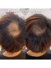【本気の育毛促進】プロセル頭皮（頭頂部、円形の抜け毛）￥50,000→￥40,000