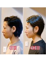 小顔22 ボルティ 赤坂支店(Bolty)/【悩み】40代：角ばった顔の輪郭