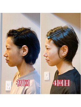 小顔22 ボルティ 赤坂支店(Bolty)/【悩み】40代：角ばった顔の輪郭