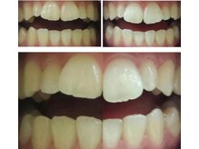 ボッカ(bocca)/ホワイトニングBefore After