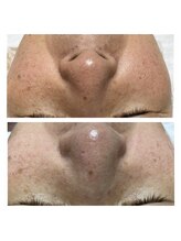 ヒラキヒミ。/毛穴洗浄エステ+上半身