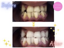 エクシアホワイトニング 天王寺店/ホワイトニングビフォーアフター