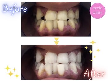 エクシアホワイトニング 天王寺店/ホワイトニングビフォーアフター